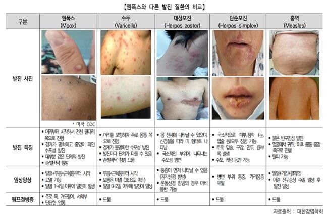 엠폭스‘주의’단계 격상.. 오산시, 감염병 감시체계 강화 (사진제공=오산시청)